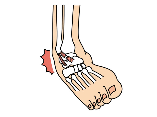 捻挫や肉離れは早めの処置が鍵